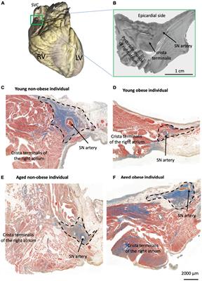 Morphology of human sinoatrial node and its surrounding right atrial muscle in the global obesity pandemic—does fat matter?